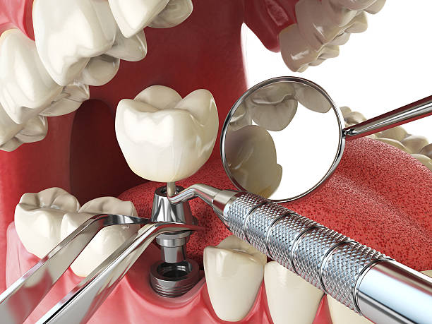 Best Emergency Dental Services for Seniors in Cayuga, IN
